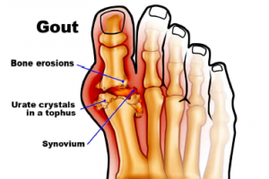 Helpful Tips About Gout Helpful Tips About Gout